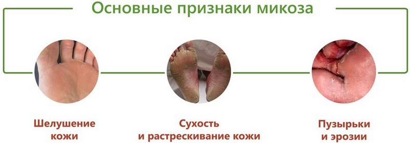 Что такое Микоз стопы (стопа Атлета) и как его лечить