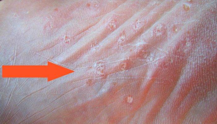 Чем лечить волдыри на ступнях ног и почему появляются водянистые пузырьки на стопе