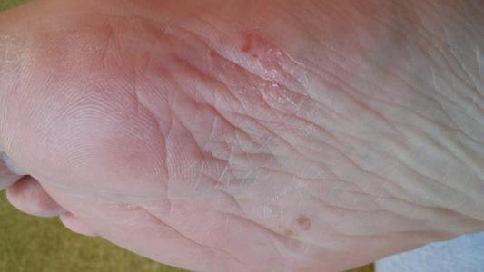 Чем лечить волдыри на ступнях ног и почему появляются водянистые пузырьки на стопе