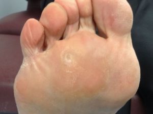 Чем лечить волдыри на ступнях ног и почему появляются водянистые пузырьки на стопе