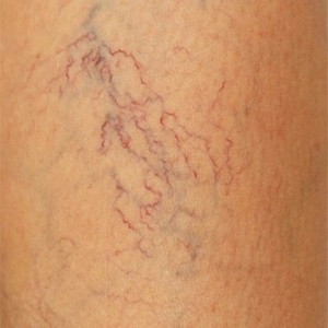 К чему приводит варикозное расширение вен на ногах у женщин