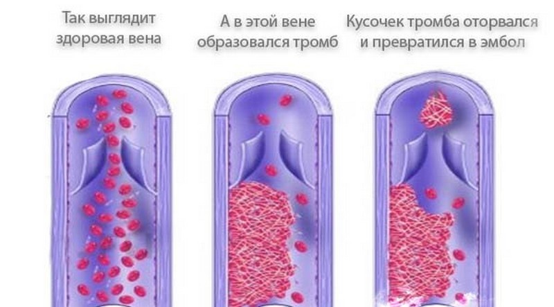 К чему приводит варикозное расширение вен на ногах у женщин
