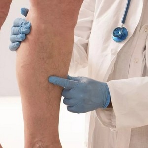 К чему приводит варикозное расширение вен на ногах у женщин