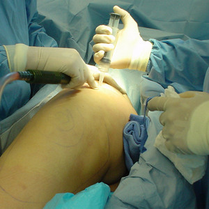 Как лечат чрезвертельный перелом бедра