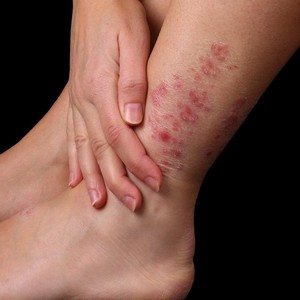 Что делать, если сильно чешется вена на ноге