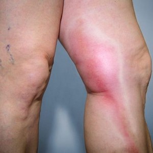 Что делать, если сильно чешется вена на ноге