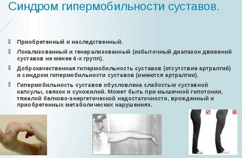 Гипермобильность суставов - болезнь или вариант нормы?