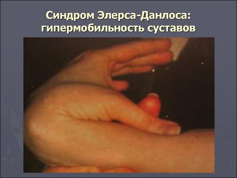 Гипермобильность суставов - болезнь или вариант нормы?