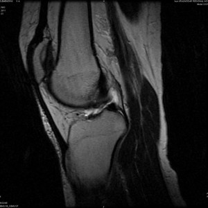 Как лечить хондромаляцию надколенника