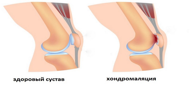 Как лечить хондромаляцию надколенника