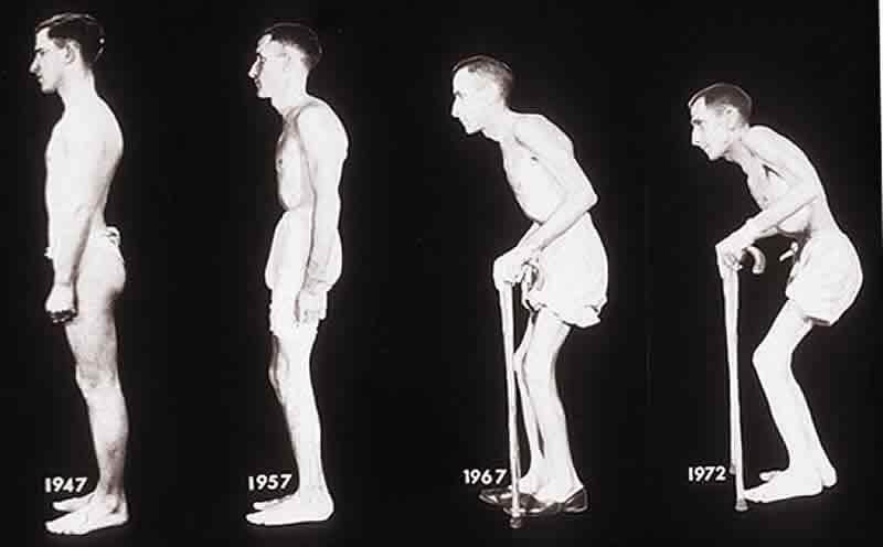 Что такое артропатия коленного сустава и как её лечить