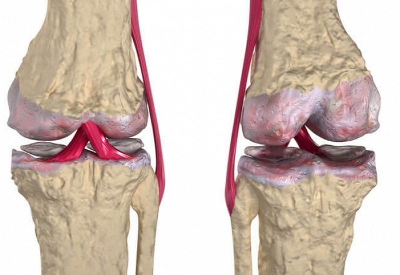 Что такое артропатия коленного сустава и как её лечить