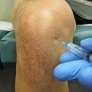 Что такое артропатия коленного сустава и как её лечить