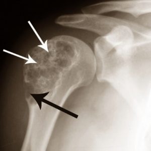 Что такое энхондрома кости и как её лечат