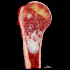 Что такое энхондрома кости и как её лечат