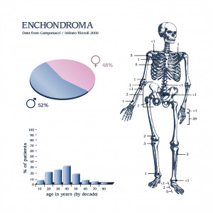 Что такое энхондрома кости и как её лечат