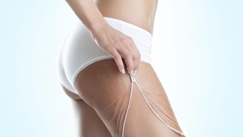 Даже не пытайтесь сделать липосакцию в домашних условиях