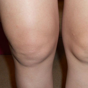 Как лечить деформирующий артроз коленных суставов