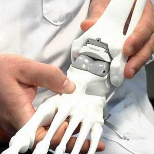 Как лечить деформирующий остеоартроз голеностопного сустава