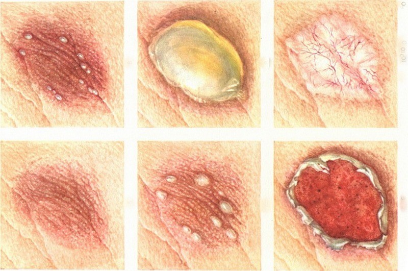 Эбермин (Hebermin): инструкция по применению мази