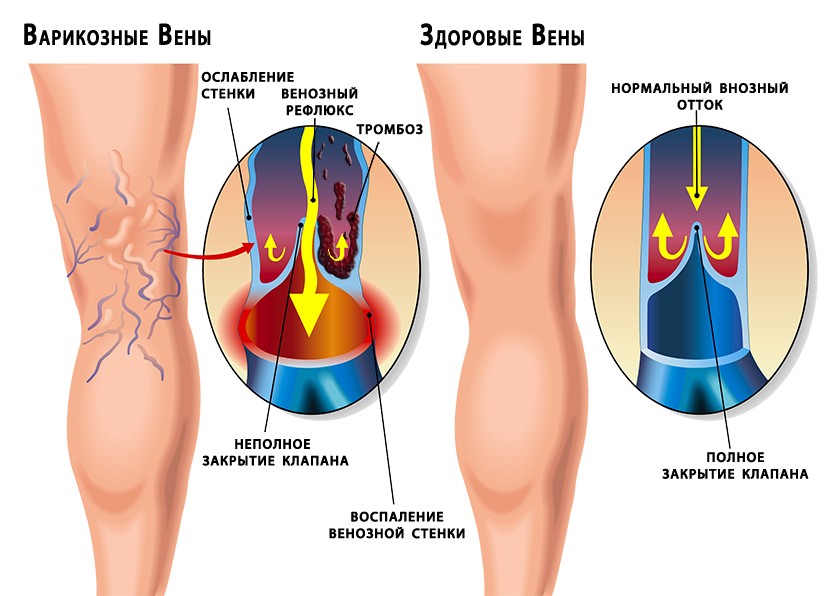Лечение варикоза эфирными маслами: отзывы пациентов
