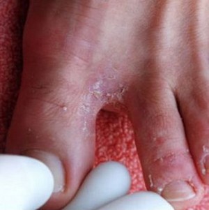 Противогрибковое средство Эконазол: инструкция по применению