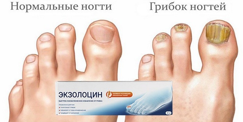 Инструкция по применению геля Экзолоцин от грибка ногтей