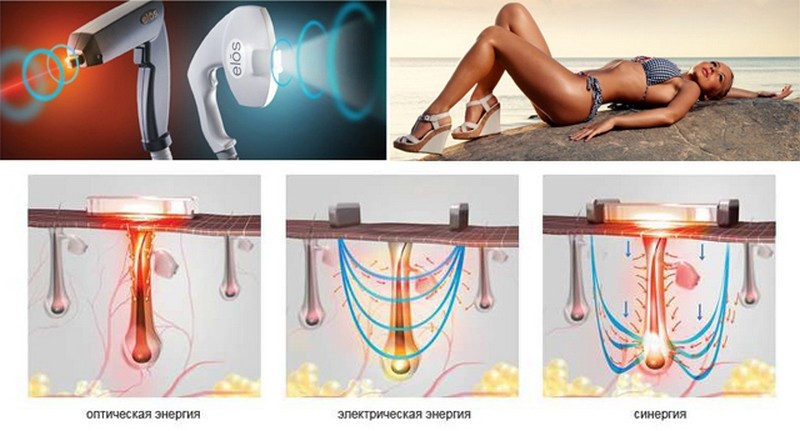 Элос (Elos) эпиляция – избавляемся от волос навсегда