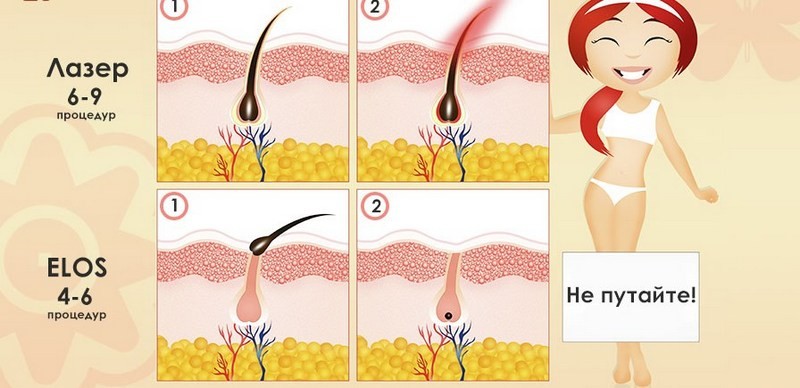 Элос (Elos) эпиляция – избавляемся от волос навсегда