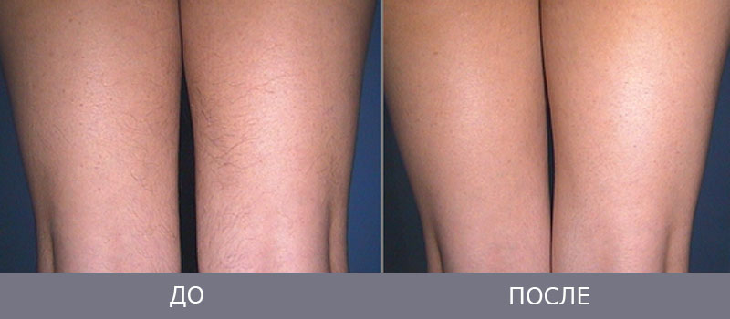 Чем отличается элос от фотоэпиляции и лазерной эпиляции и что лучше