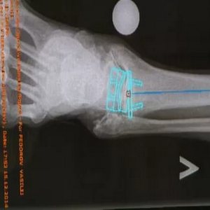 Как проходит эндопротезирование голеностопного сустава