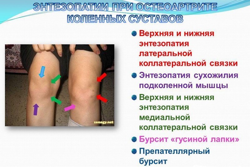 Что такое энтезопатия сустава и как её лечить