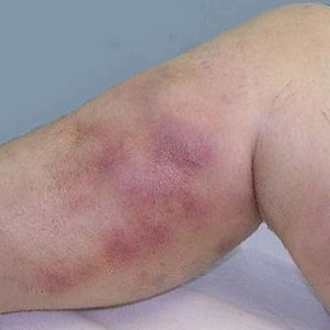 Что такое флебит и как его лечить