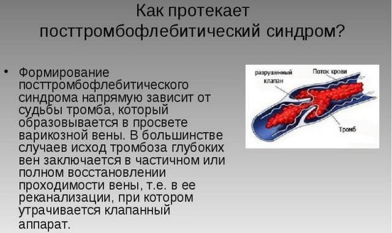 Что такое флеботромбоз, чем он отличается тромбофлебита и как его лечить
