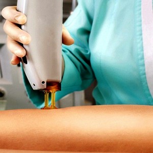 Что лучше: лазерная эпиляция или фотоэпиляция