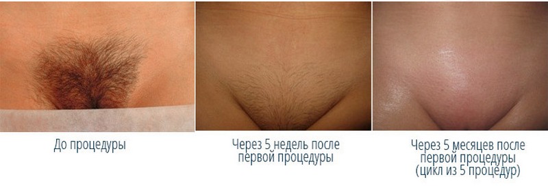 Как проводится фотоэпиляция зоны глубокого бикини