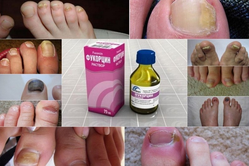Как применять Фукорцин при грибке ногтей: инструкция по применению