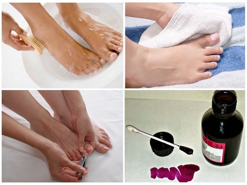 Как применять Фукорцин при грибке ногтей: инструкция по применению