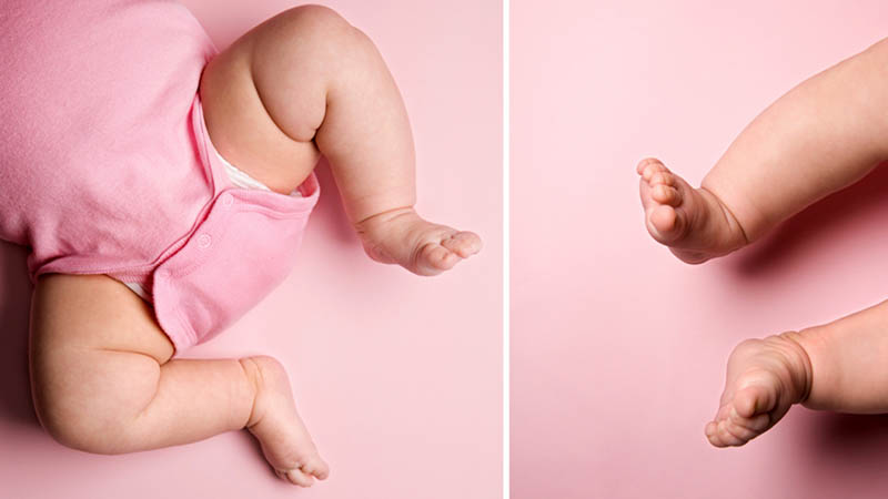 Как лечат незрелость тазобедренных суставов у новорожденных