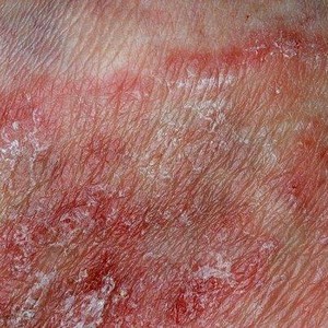 Какие есть виды грибковых заболеваний на ногах