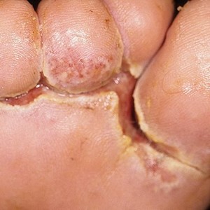 Какие есть виды грибковых заболеваний на ногах