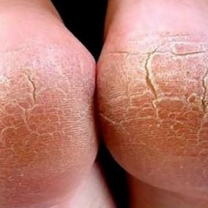 Какие есть виды грибковых заболеваний на ногах