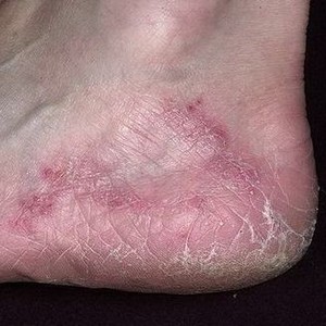 Какие есть виды грибковых заболеваний на ногах