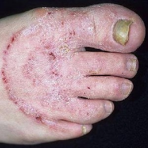 Какие есть виды грибковых заболеваний на ногах