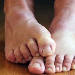 Лечение грибка ногтей Хлоргексидином