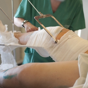 Как лечить перелом мыщелка большеберцовой кости