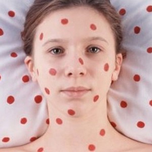 Как лечить грибок ногтей индийским луком