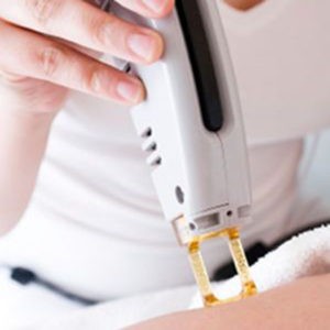 Что лучше: IPL или RF эпиляция