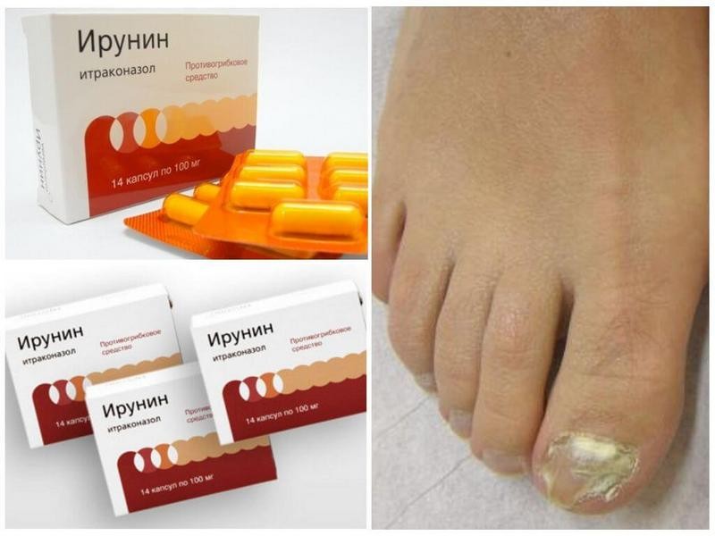 Препарат Ирунин: инструкция по применению при грибке ногтей