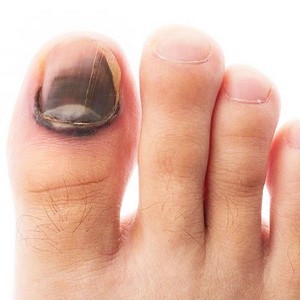 Изоконазол: инструкция по применению против грибка